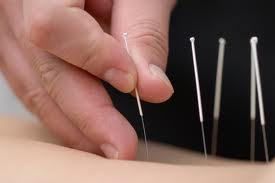 acupuncture in New York City